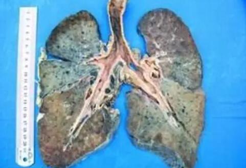 煙塵肺病——焊接麻豆视频一区二区